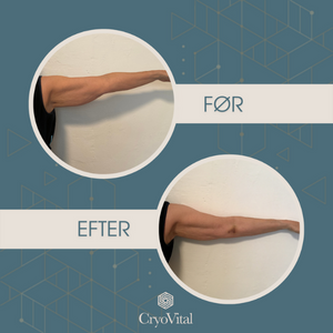 Konsultation CryoVitalShape