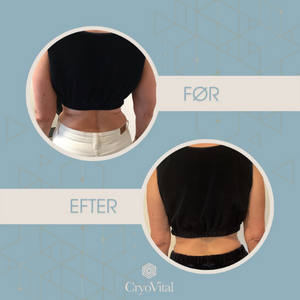 Konsultation CryoVitalShape