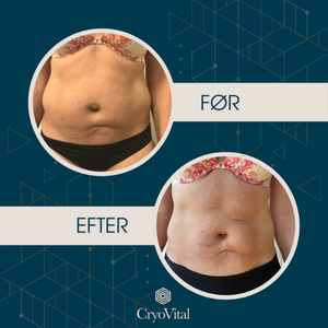 Konsultation CryoVitalShape